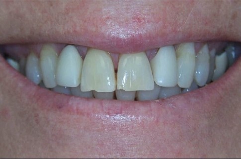 Damaged yellow teeth before cosmetic dentistry