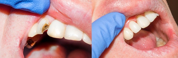 Before and after a dental crown in Wauwatosa