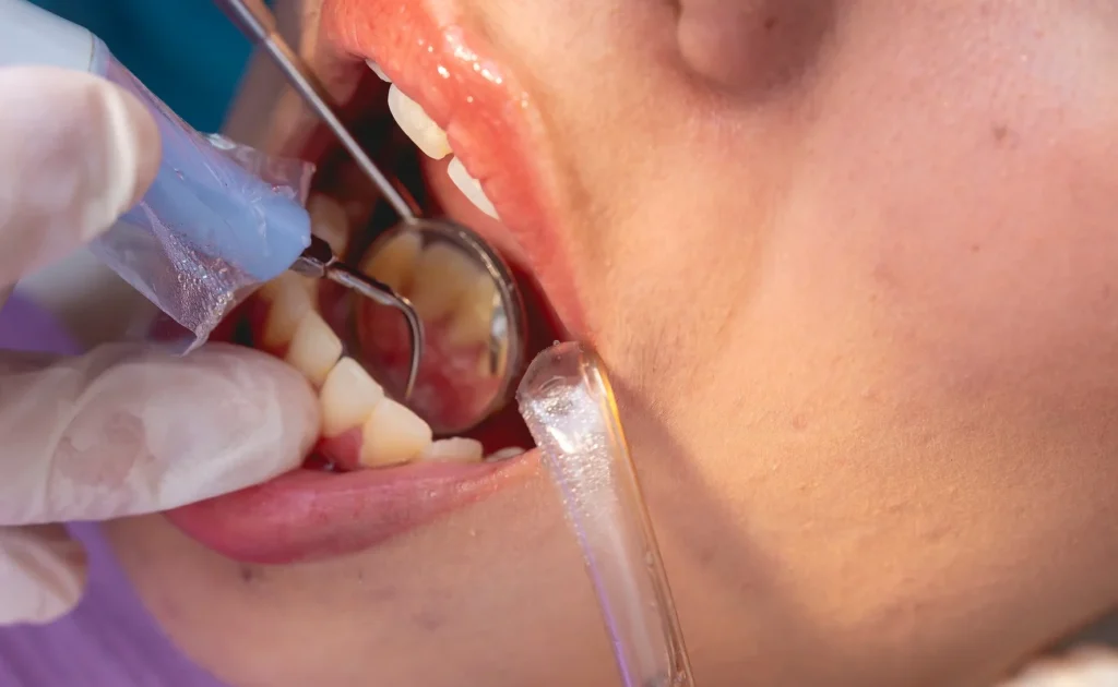 Dental tools cleaning a patient's teeth with a mirror and suction